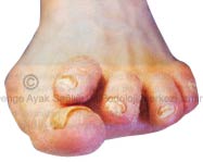 Hallux Valgus Hallux valgus tedavisi - tabanlık ve ortezleri