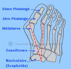 Hallux Valgus