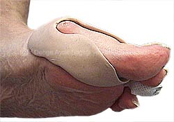 Ortoplasti