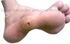 Nasır tedavisi