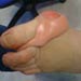 Ortoplasti - hallux valgus